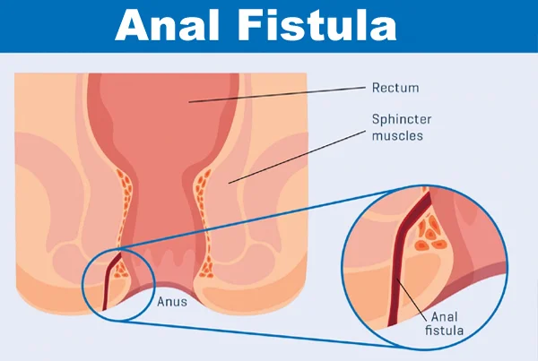 Fistula