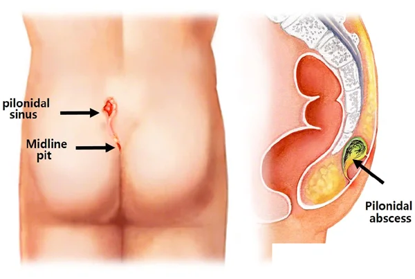Pilonidal Sinus