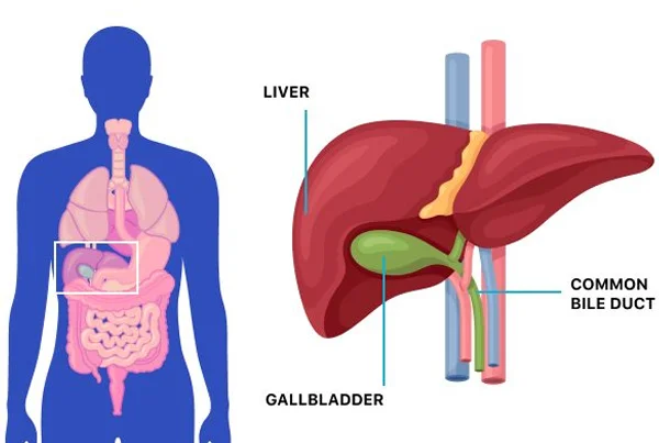Gallbladder and Kidney Stones