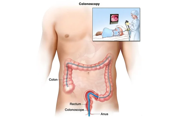 Colonoscopy