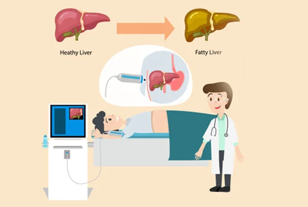 Fibroscan